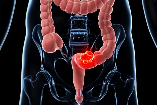 Darmkrebs: Jedes Jahr erkranken in Deutschland etwa 57.000 Menschen neu an Darmkrebs.