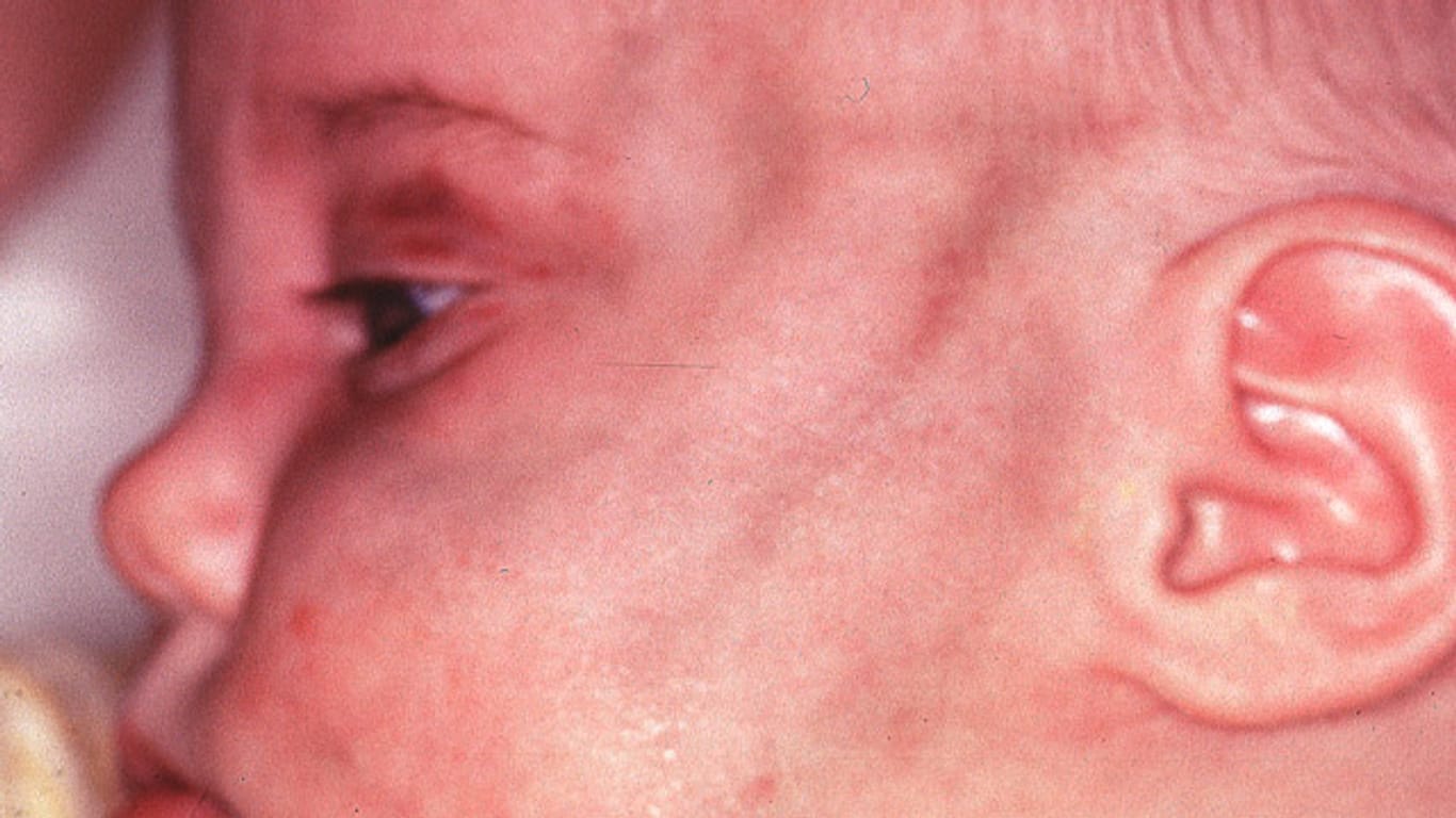 Hämatome im Gesicht eines zwei Monate alten Säuglings nach einer kräftigen Ohrfeige durch die 18 Jahre alte Mutter.