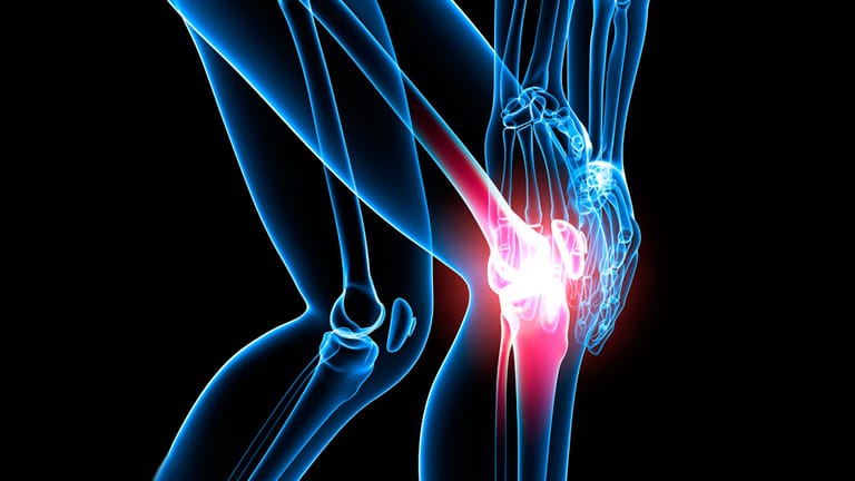 Arthrose: Vor allem Knie-, Hüft- und Schultergelenke sind von Arthrose betroffen.