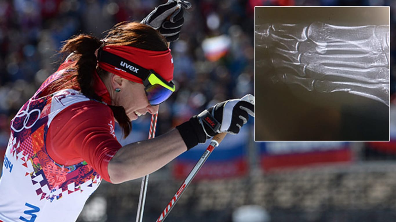 Polens Langlauf-Ass Justyna Kowalczyk beim Skiathlon in Sotschi. Rechts die Röntgenaufnahme ihres gebrochenen Fußes.