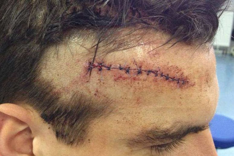 Die Schnittwunde an Christoph Moritz' Kopf wurde mit 13 Stichen genäht.