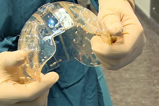 Chirurgen implantieren künstliche Schädeldecke aus 3-D-Drucker