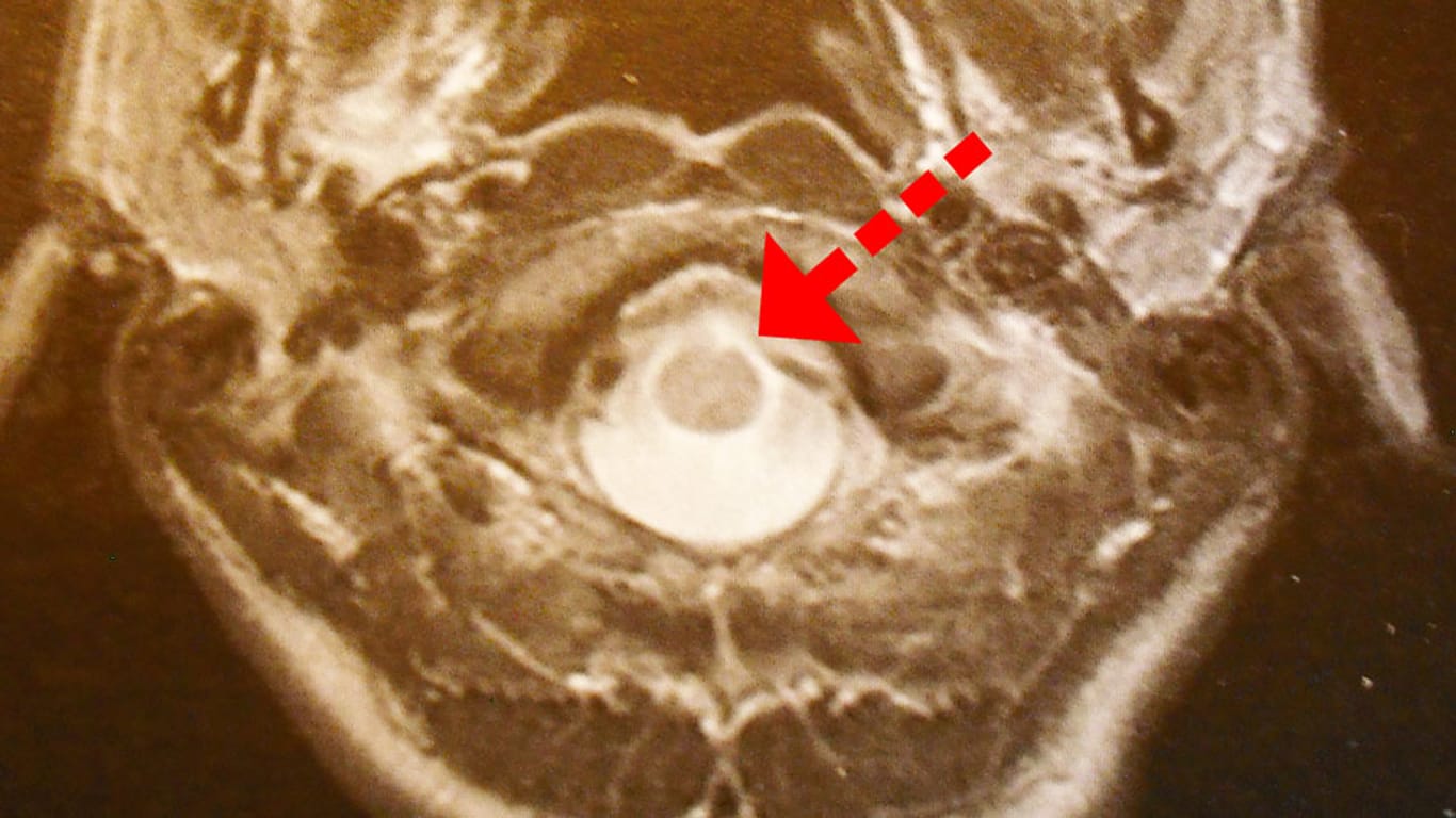 Zyste: Auf dem CT-Ausdruck ist das Gehirn von oben zu sehen.