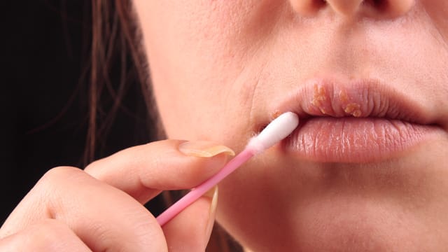 Lippenherpes kann mit speziellen Cremes behandelt werden.