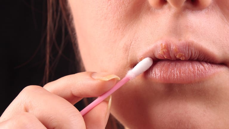 Lippenherpes kann mit speziellen Cremes behandelt werden.