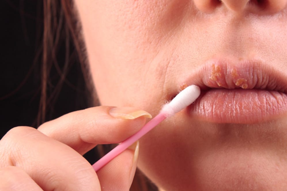 Lippenherpes kann mit speziellen Cremes behandelt werden.