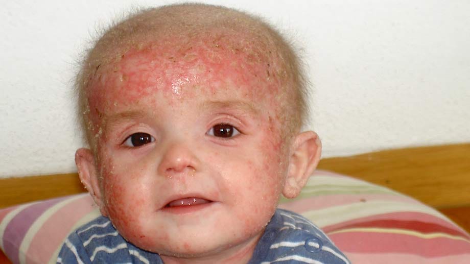 Neurodermitis - Leo erkrankte als Baby.