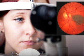 Ein Leberfleck kann auch im Augeninneren entstehen.
