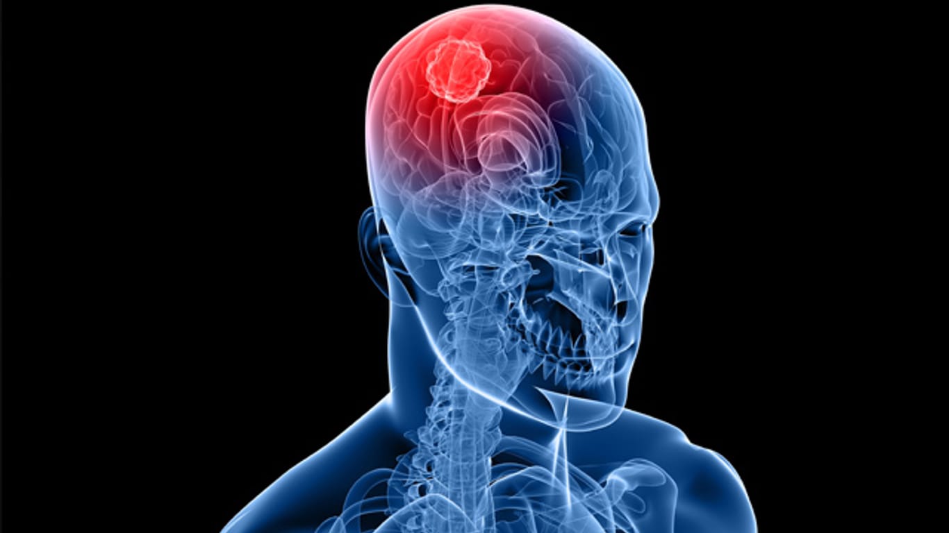 Gliome gehören zu den häufigsten und aggressivsten Hirntumoren. Die Prognosen für die Patienten sind äußerst schlecht.