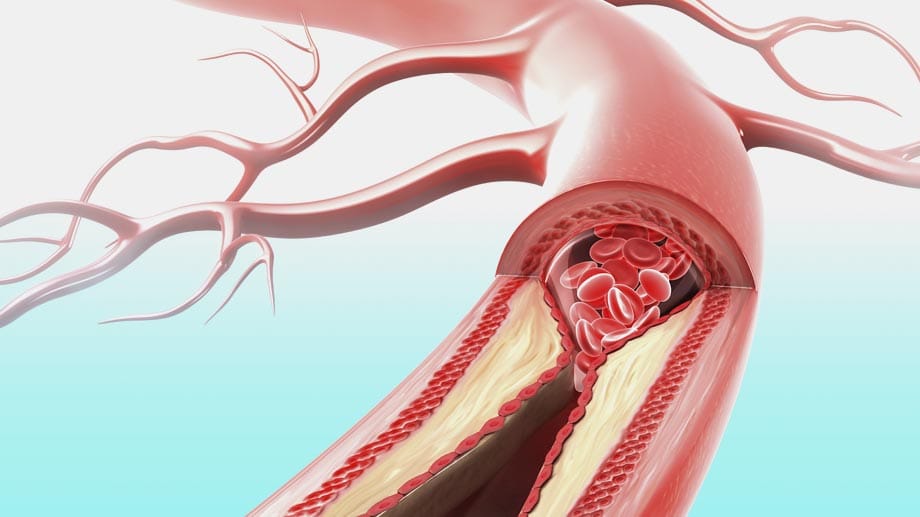 Bluthochdruck führt häufig zu Arteriosklerose. Diese kann lebensbedrohliche Folgen haben.