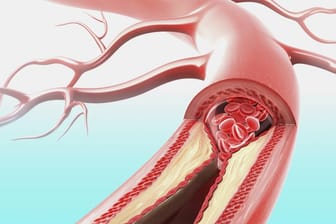 Bluthochdruck führt häufig zu Arteriosklerose. Diese kann lebensbedrohliche Folgen haben.