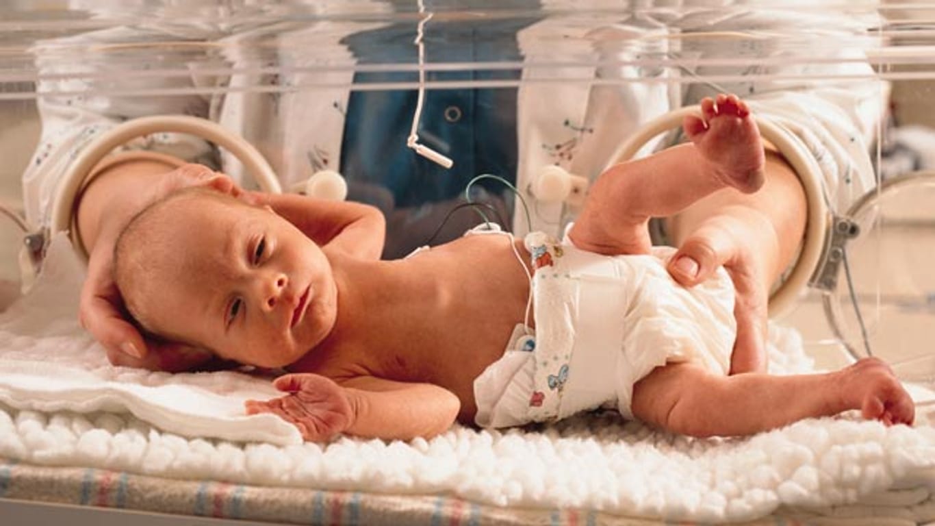 Zu früh geborene Babys haben ein erhöhtes Risiko, einen Wasserkopf zu entwickeln.