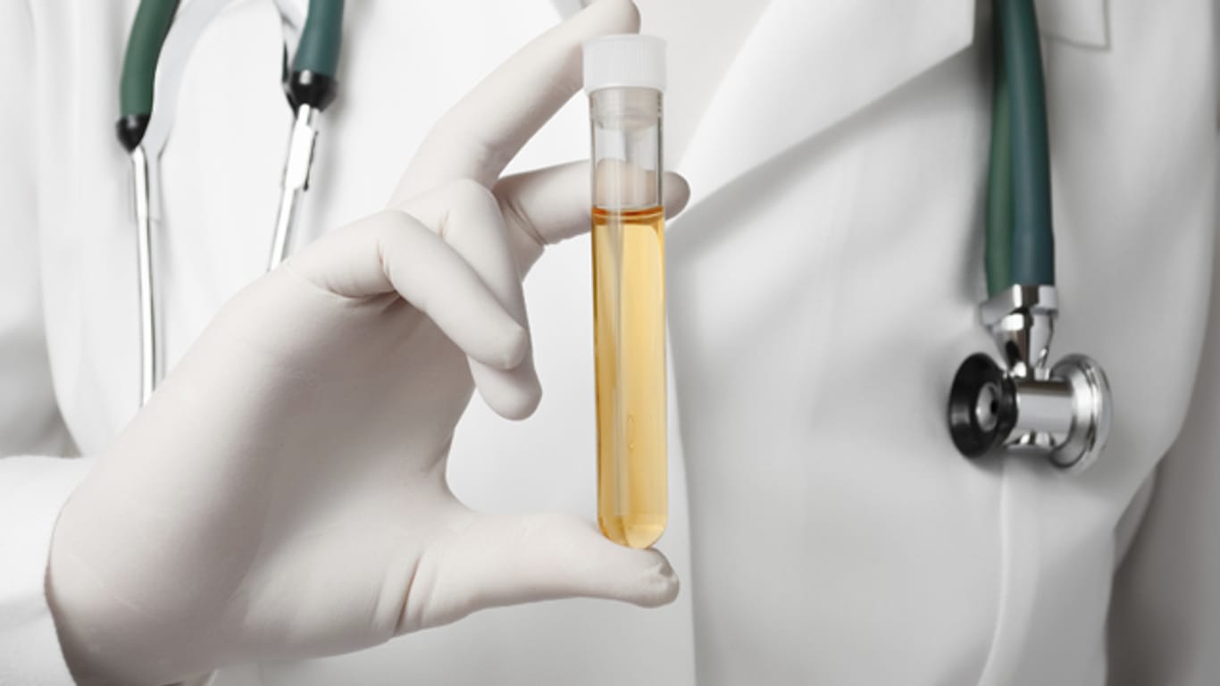 Der Chlamydien-Test mittels Urinprobe ist die gängige Variante