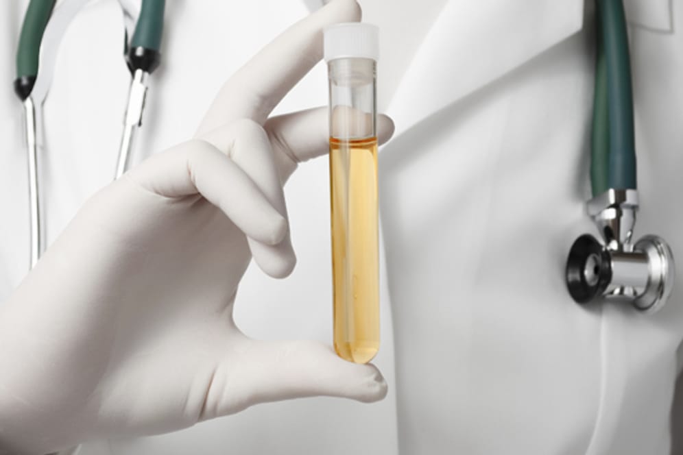 Der Chlamydien-Test mittels Urinprobe ist die gängige Variante