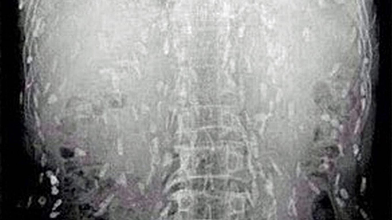 Die Röntgenaufnahme vom Oberkörper des Mannes zeigt, wie sich die Würmer ausgebreitet haben.