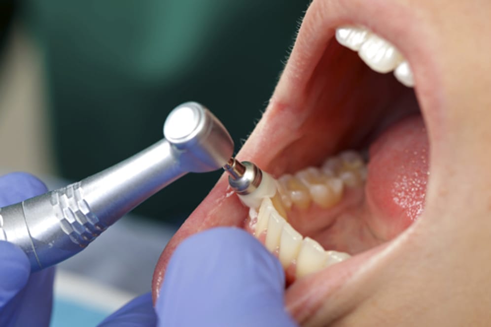 Eine professionelle Zanhreinigung befreit von Plaque und Zahnstein bei Parodontose.
