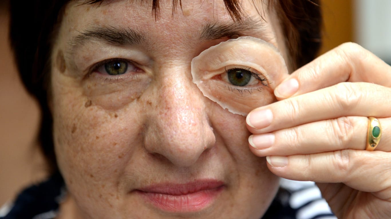 Eine Patientin im Berliner Zentrum für künstliche Gesichtsteile an der Charité in Berlin zeigt ihr Gesicht mit der Augen-Epithese.