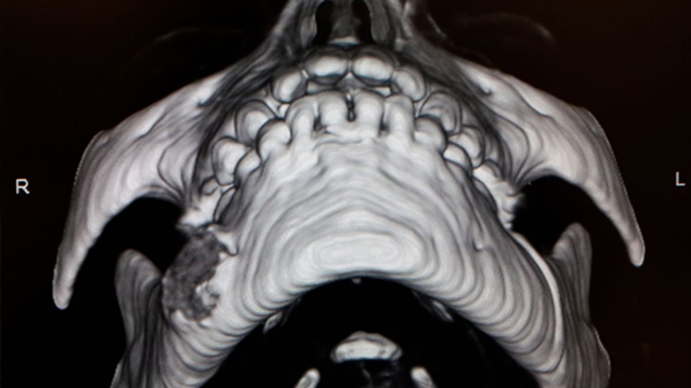 3-D-Rekonstruktion des Kiefers: Unten links im Bild (rechter Unterkiefer) ist deutlich eine Erosion des Knochens erkennbar. Die Ärzte können die Wucherung entfernen, dem Kind geht es anschließend gut.