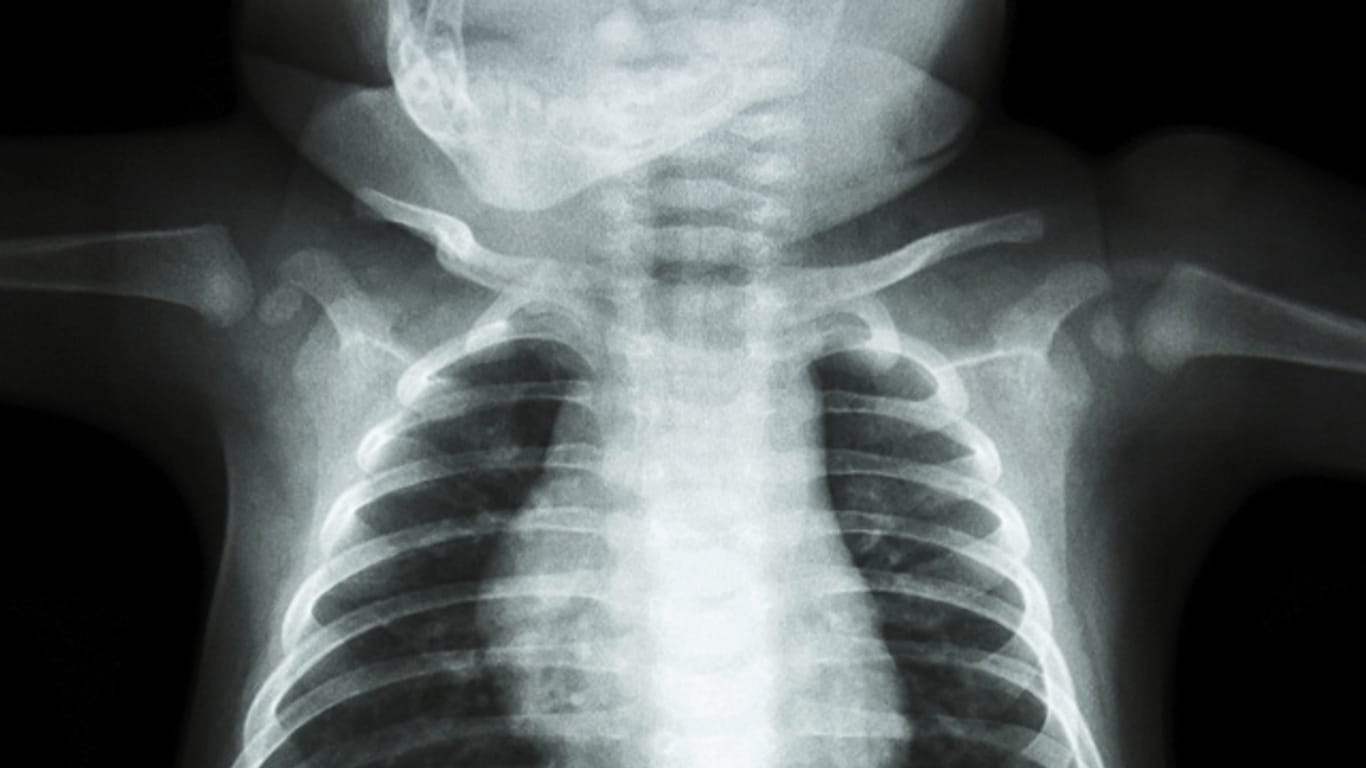 So sieht die Röntgenaufnahme eines gesunden Kindes aus.
