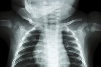 So sieht die Röntgenaufnahme eines gesunden Kindes aus.