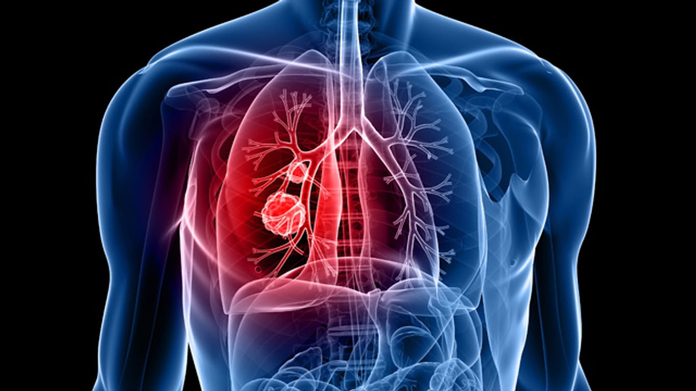 Lungenkrebs bleibt häufig zu lange unerkannt.