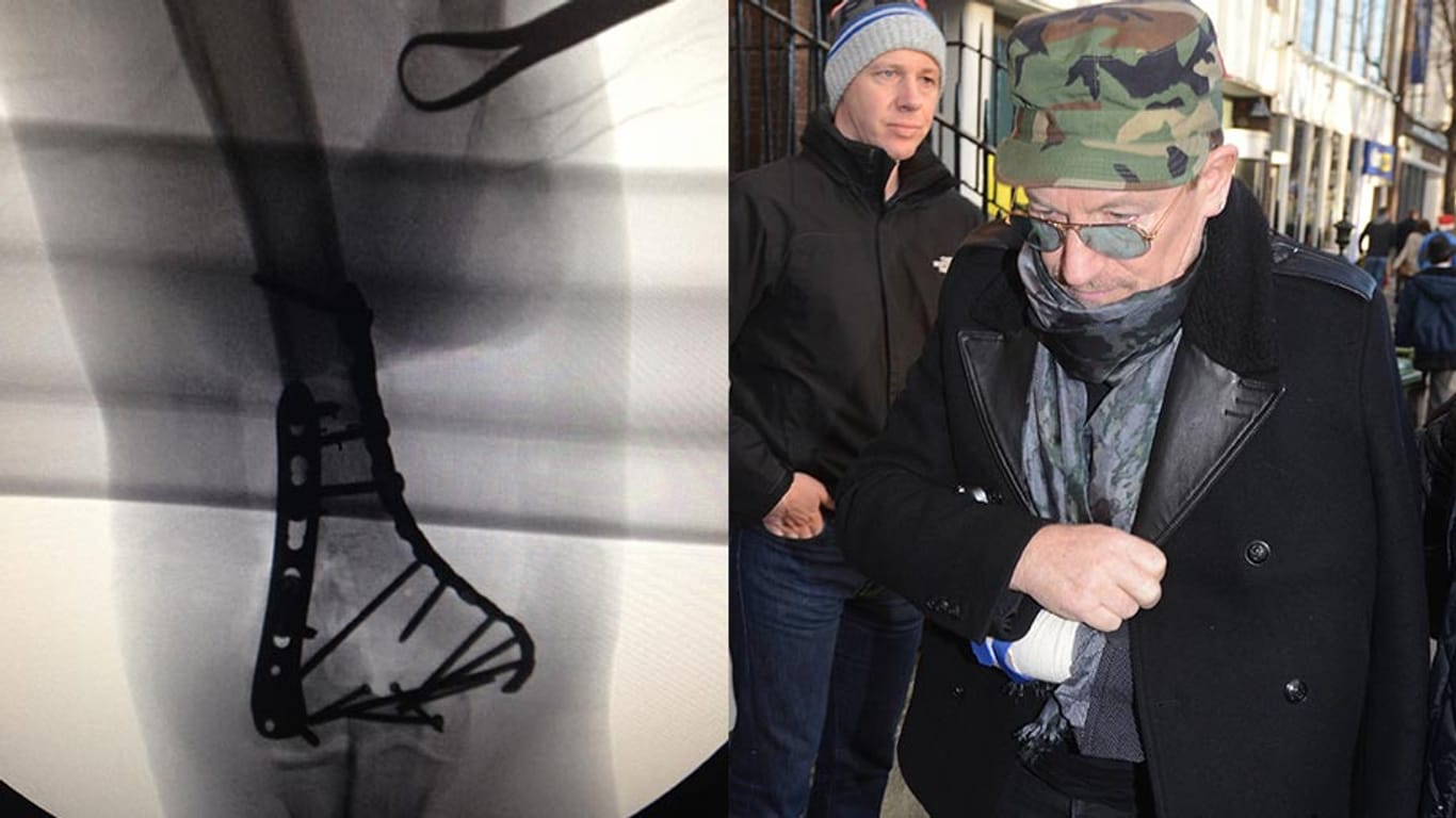 Röntgenbild von Bonos Ellbogen, der Sänger mit seinem verletzten Arm in einer Schlinge in Dublin.