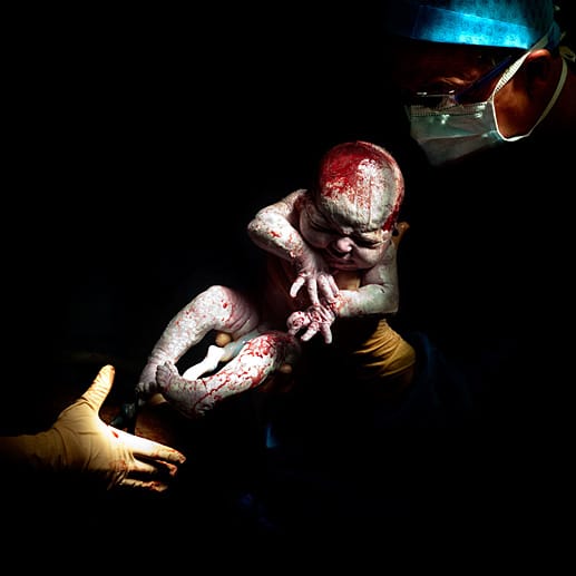Fest im Griff: Damit die 14 Sekunden alte Louann den Ärzten nicht aus den behandschuhten Händen rutscht, müssen sie sicher nach ihr greifen. Louann kam am 12. April 2013 auf die Welt.