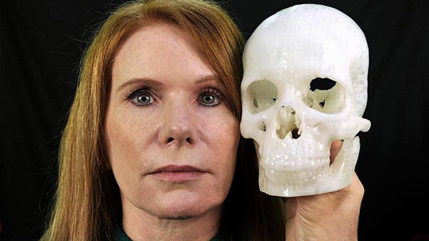 Tumor-Patientin Pamela Shavaun Scott mit einem 3D-Modell ihres Schädels.