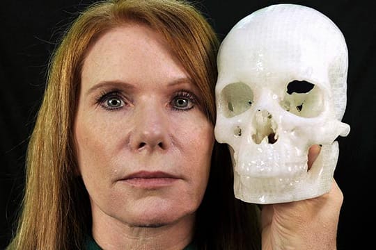 Tumor-Patientin Pamela Shavaun Scott mit einem 3D-Modell ihres Schädels.