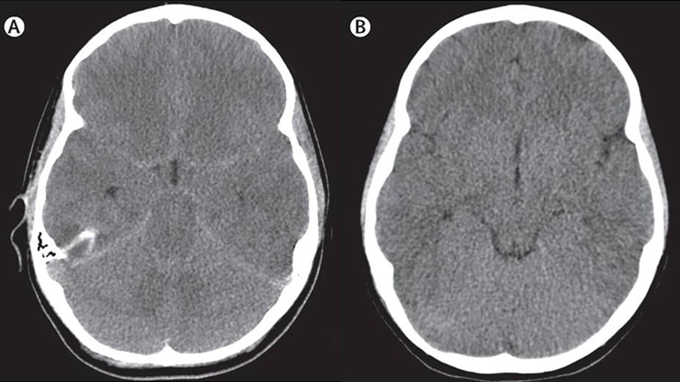 CT-Aufnahme des Kopfes: Das Hirn ist geschwollen, Flüssigkeit hat sich angesammelt.