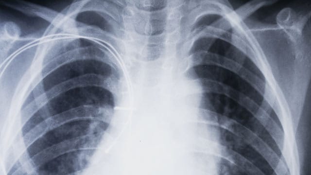 Röntgenaufnahme eines Brustkorbs: Woher kommt die Luftnot? Röntgenaufnahme eines Brustkorbs: Woher kommt die Luftnot?