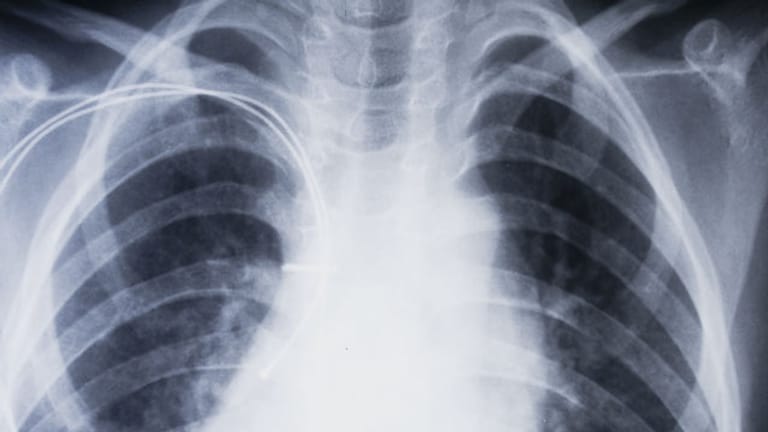 Röntgenaufnahme eines Brustkorbs: Woher kommt die Luftnot?