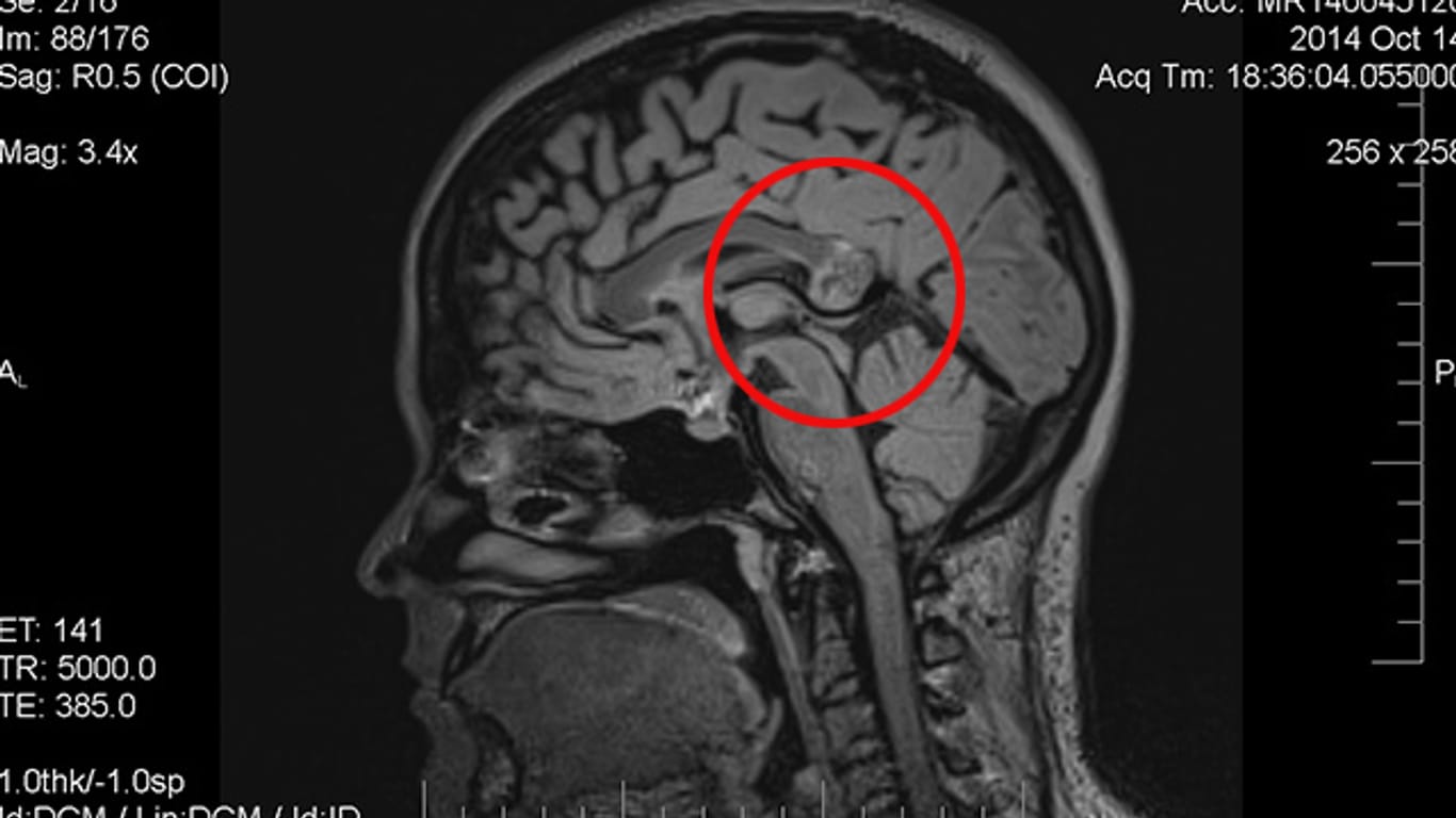 MRT-Bild des Hirns der Frau mit dem Embryo im Kopf. Die markierte Stelle hielten die Ärzte zunächst für einen Tumor.