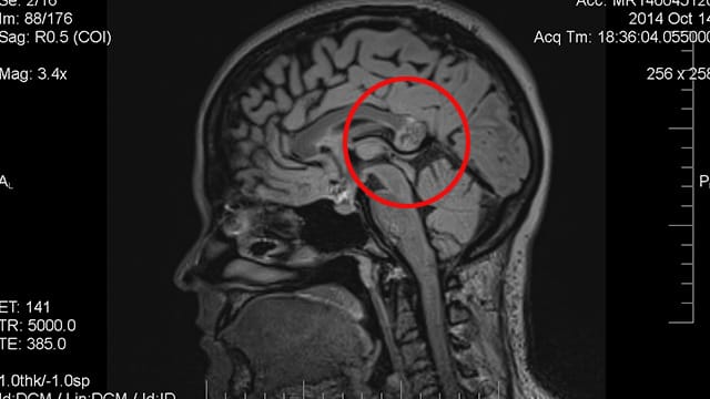 MRT-Bild des Hirns der Frau mit dem Embryo im Kopf. Die markierte Stelle hielten die Ärzte zunächst für einen Tumor. MRT-Bild des Hirns der Frau mit dem Embryo im Kopf. Die markierte Stelle hielten die Ärzte zunächst für einen Tumor.