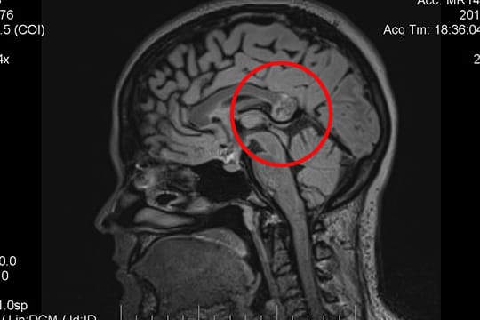 MRT-Bild des Hirns der Frau mit dem Embryo im Kopf. Die markierte Stelle hielten die Ärzte zunächst für einen Tumor.