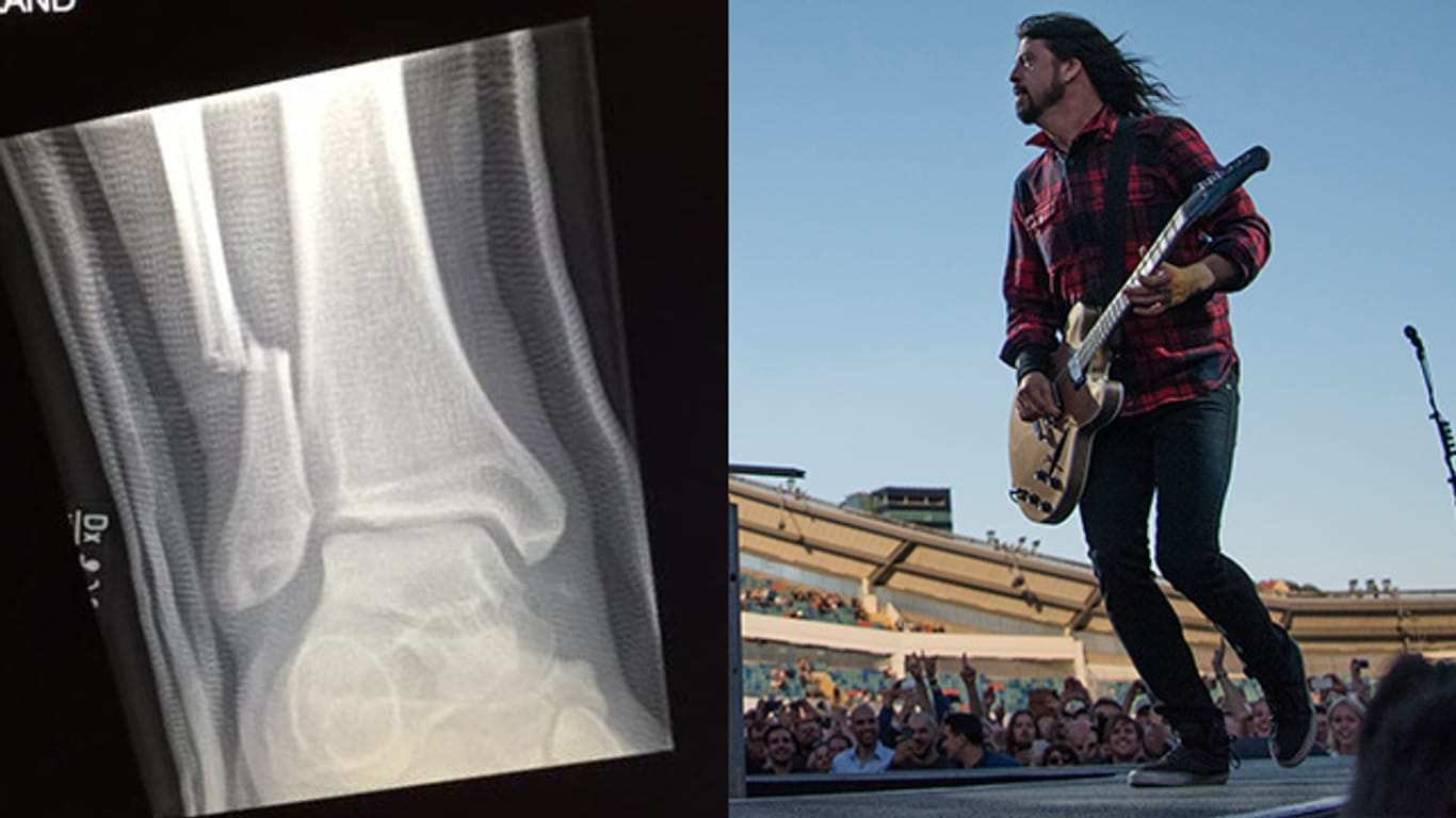Foo Fighters-Sänger Dave Grohl kurz vor seinem Sturz von der Bühne. Später twitterte er ein Foto seines gebrochenen Knochens.