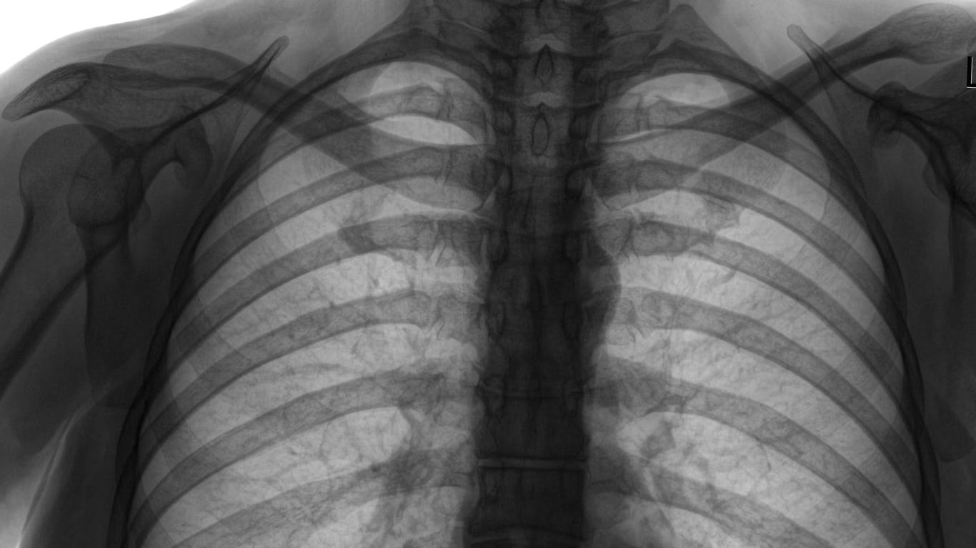 Röntgenaufnahme des oberen Brustkorbs.