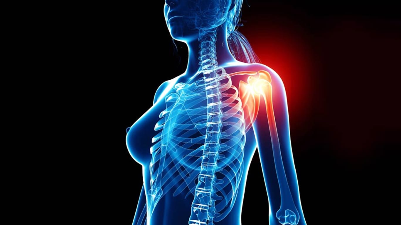 Schmerzen in der Schulter: Bei einer Kanadierin tippt ein Arzt zuerst auf eine Entzündung der Knochen.
