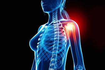 Schmerzen in der Schulter: Bei einer Kanadierin tippt ein Arzt zuerst auf eine Entzündung der Knochen.