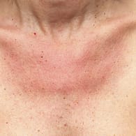 Sonnenallergie sonnencreme - Die preiswertesten Sonnenallergie sonnencreme ausführlich analysiert