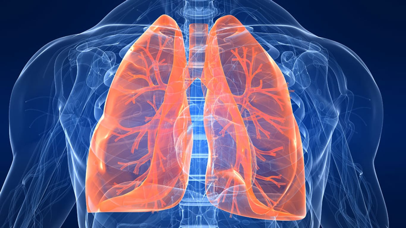 Bei einer Lungenembolie verstopft ein Blutgerinnsel die Gefäße in der Lunge.