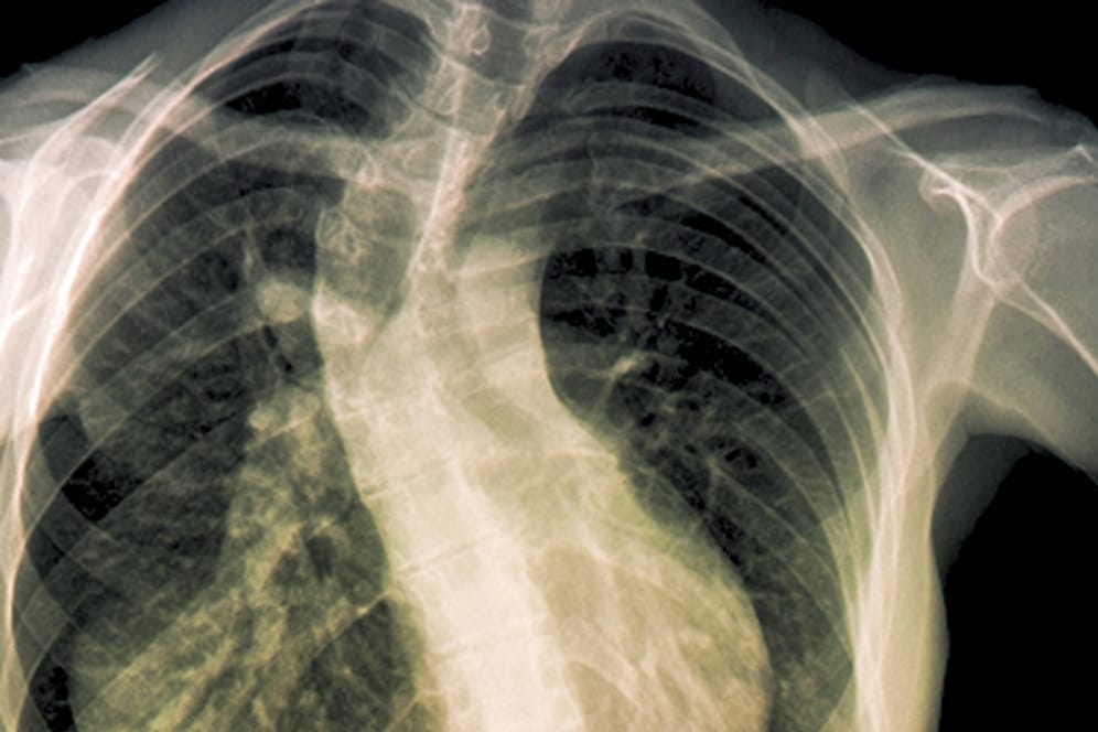 Skoliose: Dieses Röntgenbild zeigt deutlich die verdrehte Wirbelsäule einer Skoliose-Patientin.