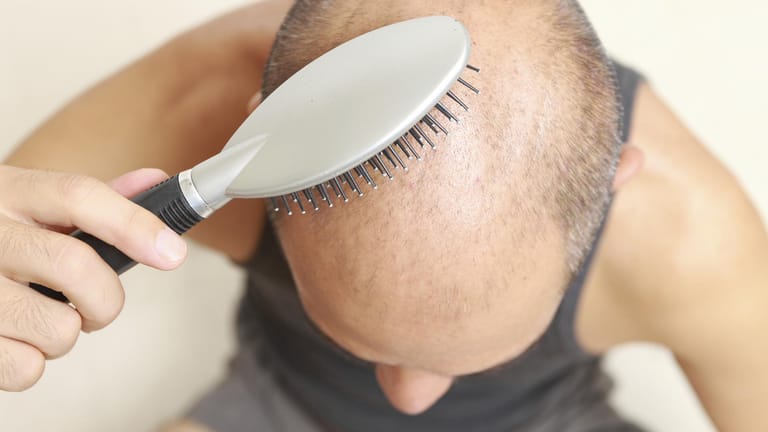 Haarausfall bei Männern ist meist erblich bedingt.