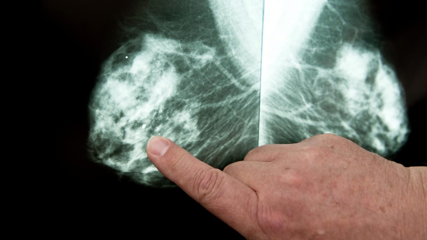 Mammografie: Durch Screening-Programme wird Brustkrebs früher entdeckt - und häufiger die Diagnose DCIS gestellt.
