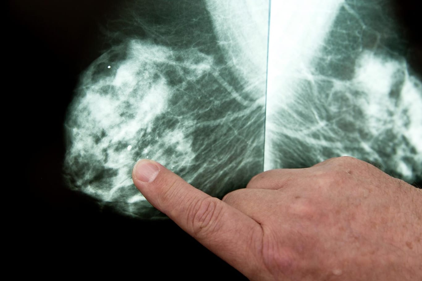 Mammografie: Durch Screening-Programme wird Brustkrebs früher entdeckt - und häufiger die Diagnose DCIS gestellt.