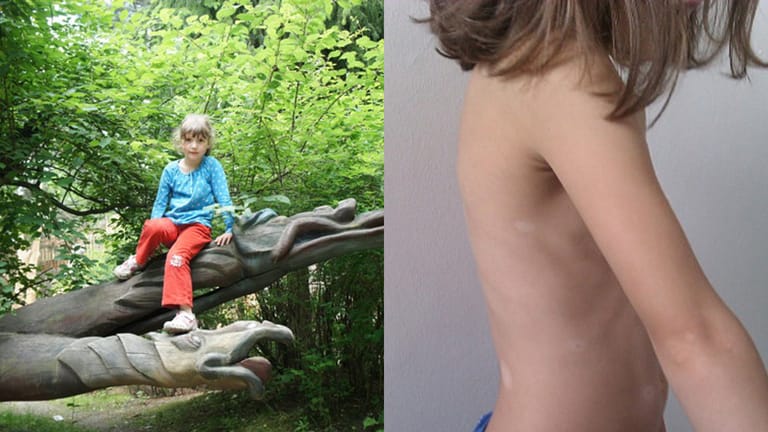 Vitiligo: Auf der Haut der siebenjährigen Lena zeigen sich immer mehr weiße Flecken.