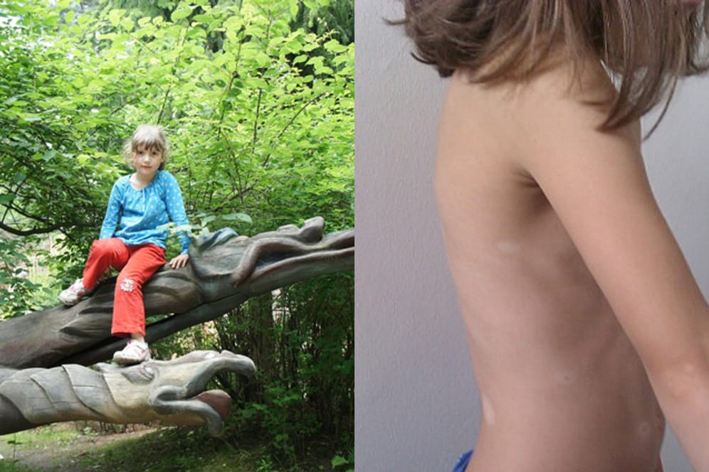 Vitiligo: Auf der Haut der siebenjährigen Lena zeigen sich immer mehr weiße Flecken.