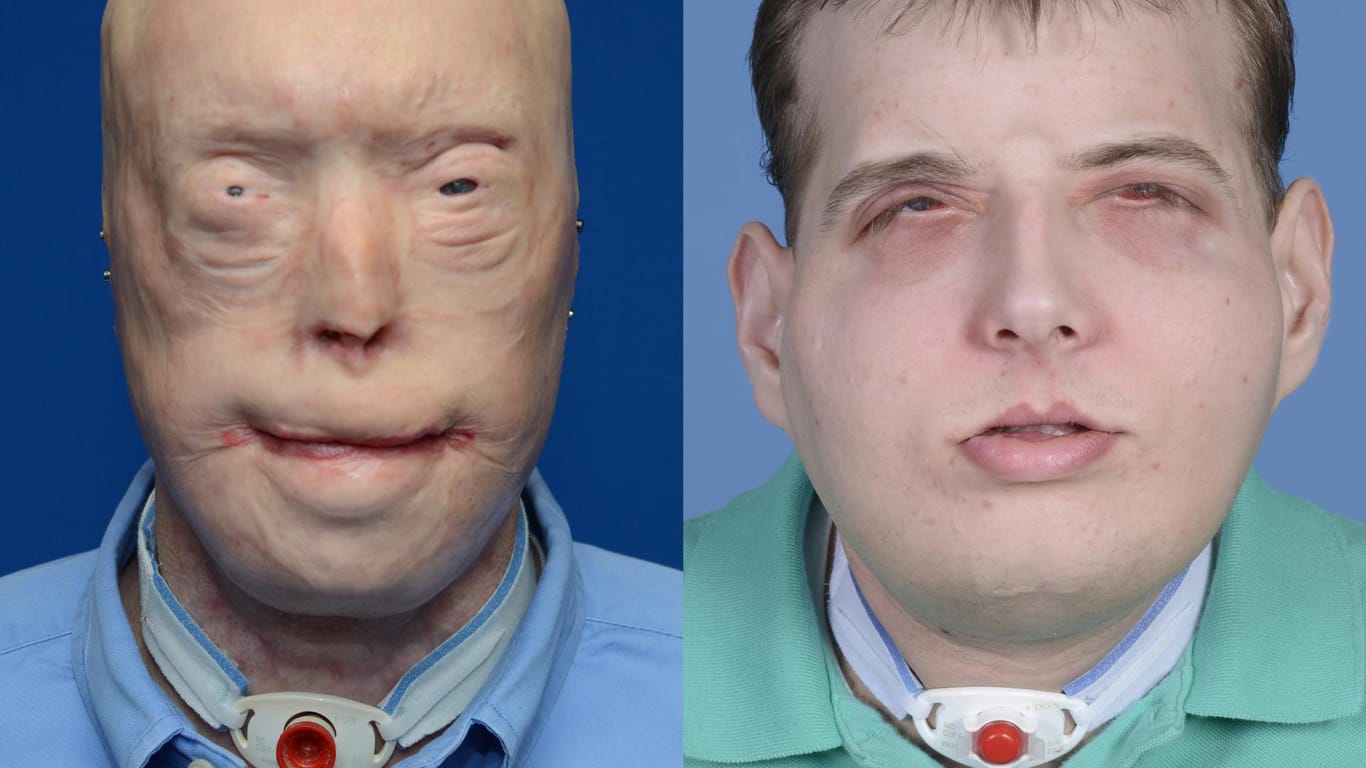 Nach 14 Jahren wieder normale Gesichtszüge: Ein Vorher-nachher-Bild zeigt die Verwandlung des ehemaligen Feuerwehrmannes Patrick Hardison.