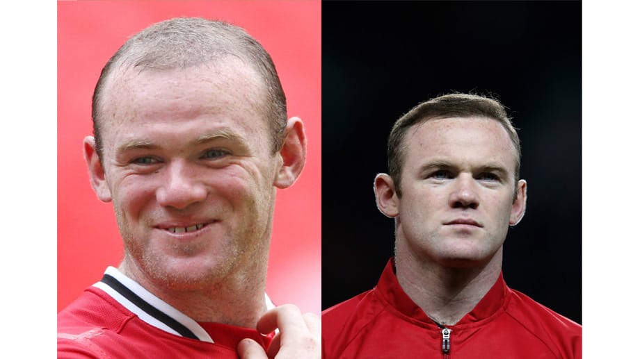 Auch Fußballer Wayne Rooney ließ sich Haare verpflanzen. Vielleicht wäre das dank Eigenblut gar nicht nötig gewesen.