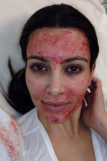 Beauty Kim Kardashian ließ ihre Fans via Instagram an ihrem blutigen Eingriff teilhaben.